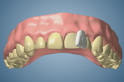 Stained Teeth and Veneers